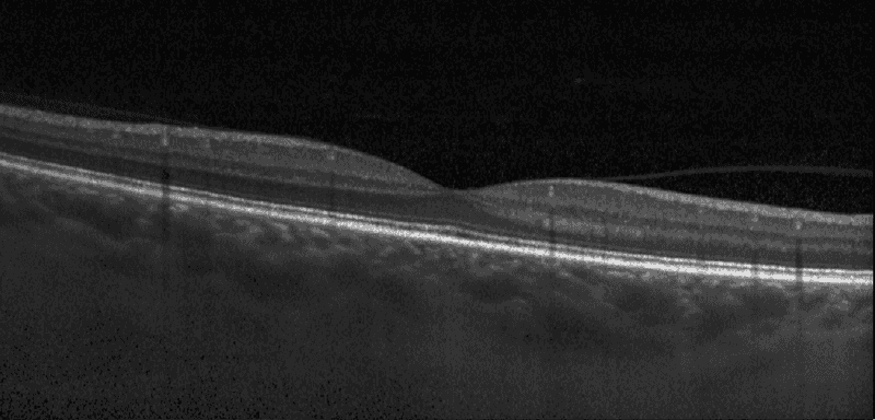 a healthy retina imaged with optical coherence tomography, showing smooth, well defined parallel layers
