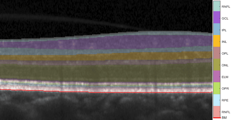 a close-up OCT image of a healthy retina with all ten retinal layers, RNFL, GCL, IPL, INL, OPL, ELM, OPR, RPE and Bruch's membrane, segmented and colored to show how the retina is represented in OCT and how it can be segmented