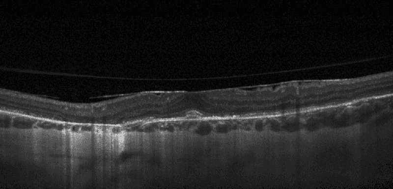 an OCT scan of a retina affected by Pseudoxanthoma Elasticum, with bright, disrupted spots and layers that are harder to distinguish from each other